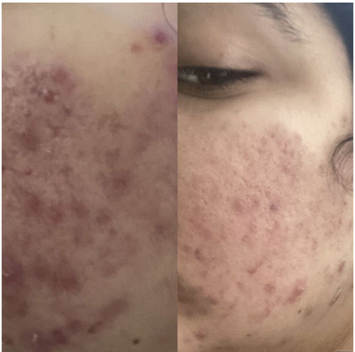 Customer photo review of FCL Penta Peel Pads | Removes Dead Skin Cells