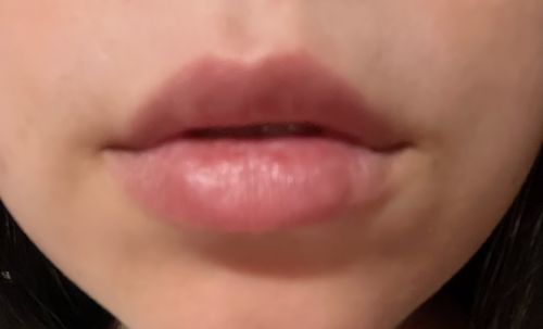 Customer photo review of LipFix: Filler
