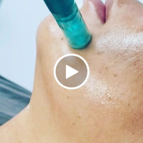 Customer video review of Nano Pin Cartridges for Dr. Pen A6S (10 Pack)