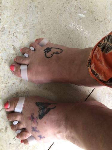 Customer photo review of BODYFEET ALIGNERS KIT