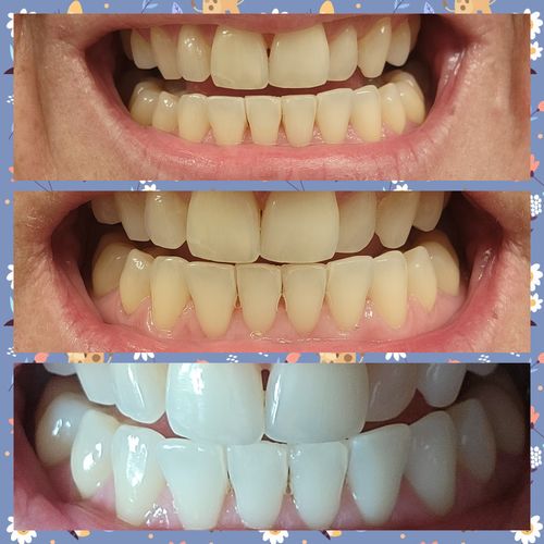 Customer photo review of GLO405™ Teeth Whitening Kit