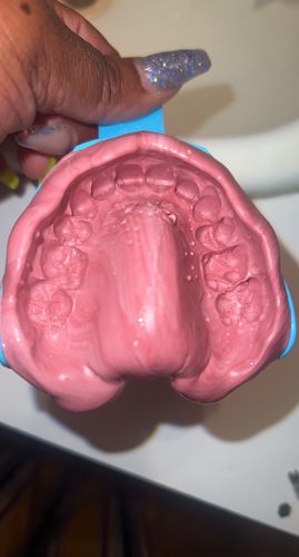 Customer photo review of Upper and Lower Retainers