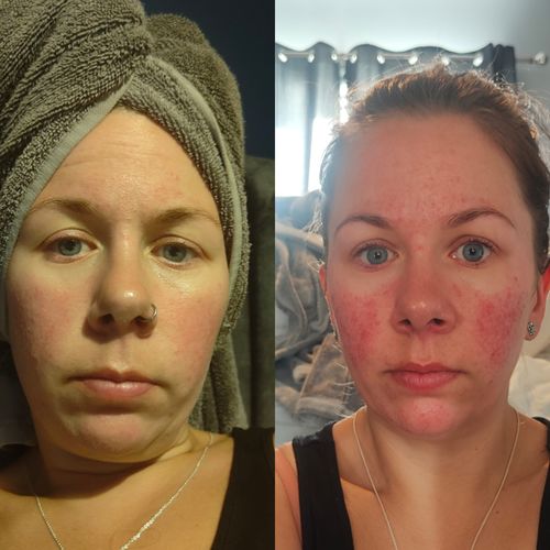 Customer photo review of Rosalique 3 in 1 Anti-Redness Miracle Formula SPF50