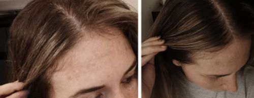 Customer photo review of HairRebirth Herbal Spray(Limited time discount 🔥 last day)