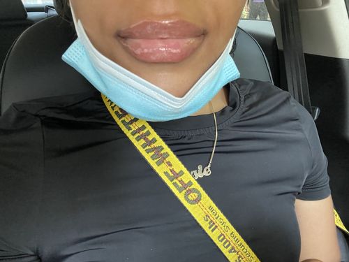 Customer photo review of LipFix: Filler