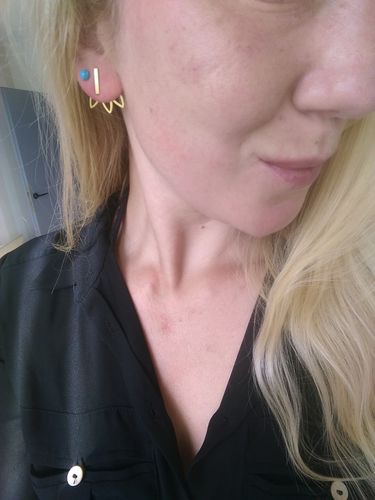 Customer photo review of Rosalique 3 in 1 Anti-Redness Miracle Formula SPF50