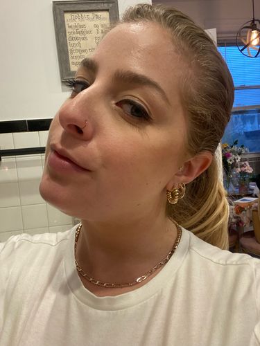 Customer photo review of ChinFix: Filler