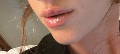 Customer photo review of LipFix: Filler