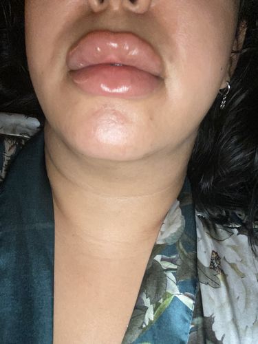 Customer photo review of LipFix: Filler