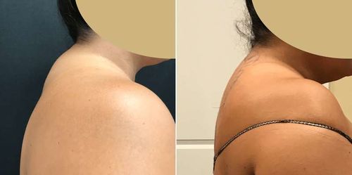 Customer photo review of TechTico EMS Lymphatic Relief Neck Massager