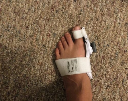 Customer photo review of The BigToeHero™