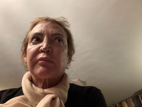 Customer photo review of FaceFix: Sculptra