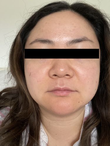 Customer photo review of EvenSkyn® Lumo: Premium Anti-Aging & Skin Tightening Handset
