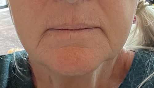 Customer photo review of EvenSkyn® Lumo: Premium Anti-Aging & Skin Tightening Handset