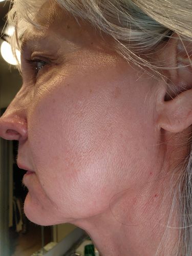 Customer photo review of EvenSkyn® Lumo: Premium Anti-Aging & Skin Tightening Handset