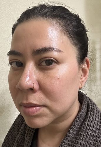 Customer photo review of EvenSkyn® Lumo: Premium Anti-Aging & Skin Tightening Handset