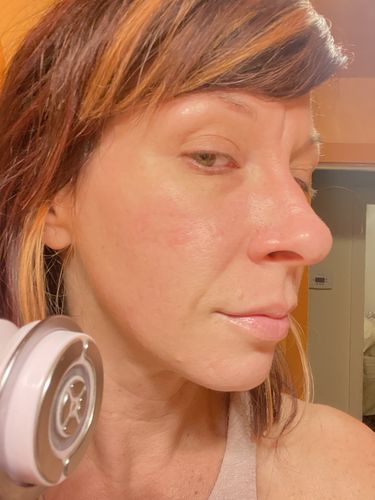 Customer photo review of EvenSkyn® Lumo: Premium Anti-Aging & Skin Tightening Handset
