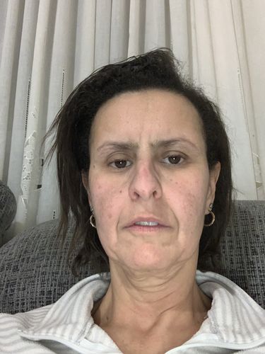 Customer photo review of EvenSkyn® Lumo: Premium Anti-Aging & Skin Tightening Handset