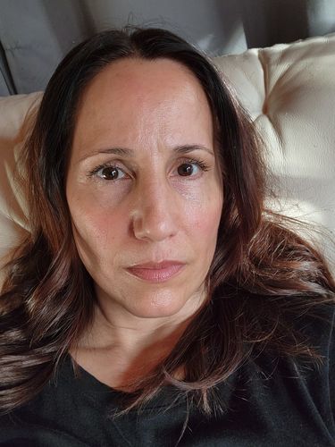 Customer photo review of EvenSkyn® Lumo: Premium Anti-Aging & Skin Tightening Handset