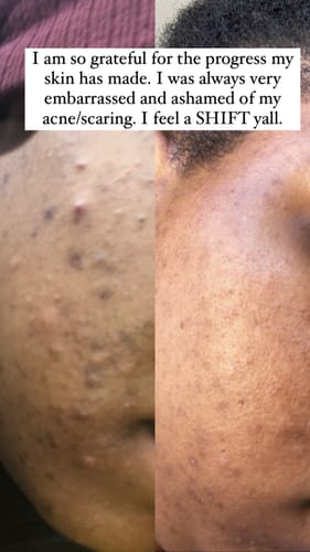 Customer photo review of 24k Golden Glow Essential Acne Kit
