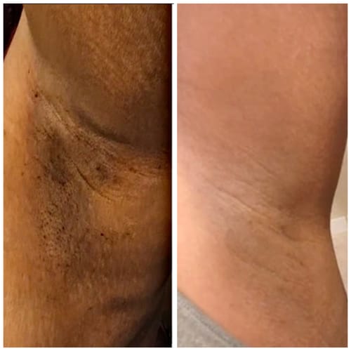 Customer photo review of Body Brightening Kit