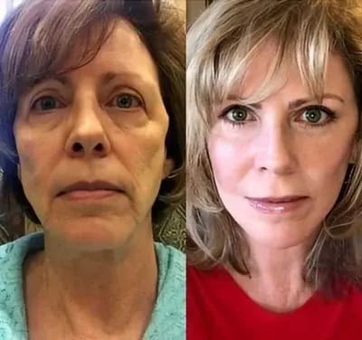 Customer photo review of DermaLux™ Korean Dermalayr Technology Soluble Collagen Film