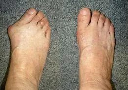 Customer photo review of 🐝 【Official Brand Store】 New Zealand Bee Venom Pain and Bone Healing Cream