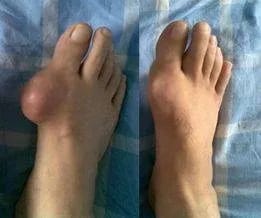 Customer photo review of 🐝 【Official Brand Store】 New Zealand Bee Venom Pain and Bone Healing Cream