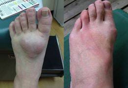 Customer photo review of 🐝 【Official Brand Store】 New Zealand Bee Venom Pain and Bone Healing Cream