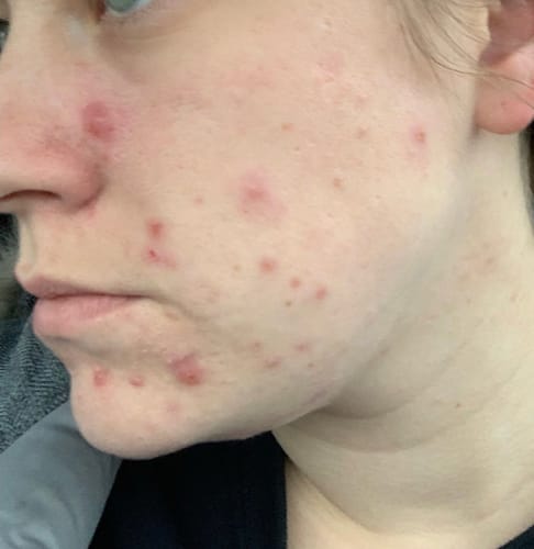 Customer photo review of Corthe Dermo Pure First Aid Cleansing Foam