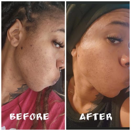 Customer photo review of BERRI-CLEAR+ 5 BERRY SUPERFRUIT SERUM