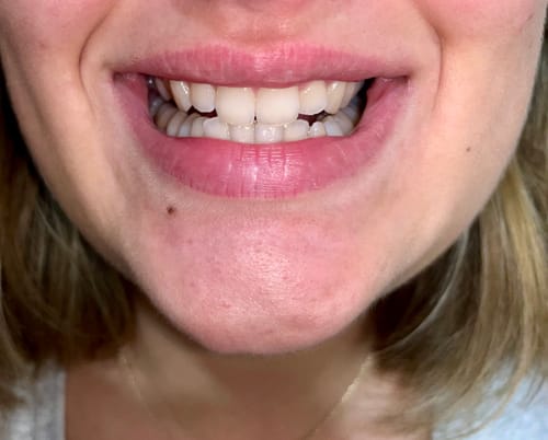 Customer photo review of ETERNAL TEETH WHITENING KIT