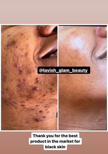 Customer photo review of 24k Golden Glow Essential Acne Kit