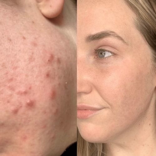 Customer photo review of 🔥Hot Sale🔥 - Poreless Deep Cleanse Green Tea Mask