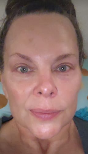 Customer photo review of Dermathod O2 Tox Peel (Spicule Treatment)