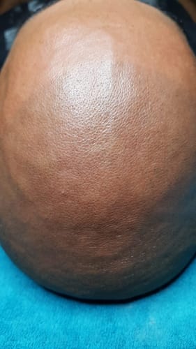 Customer photo review of KrX Premium Meso Hair Solution