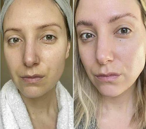 Customer photo review of NoolaWand™ Handset + FREE NoolaBar™ Microcurrent Device