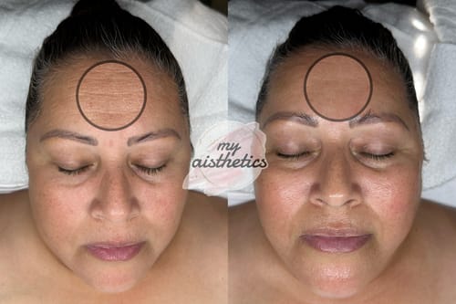 Customer photo review of KrX CO2 Carboxy Therapy