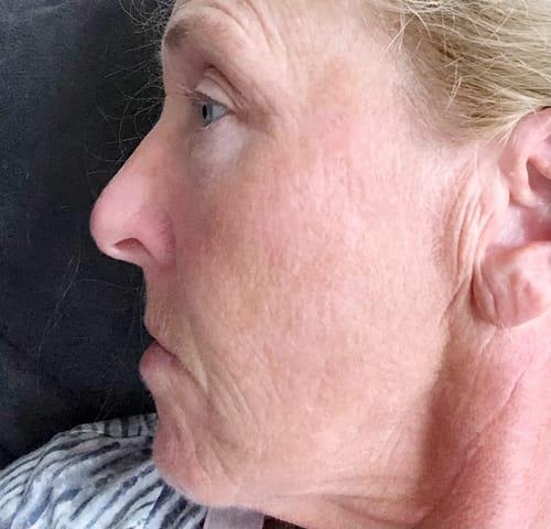 Customer photo review of NoolaWand™ Handset + FREE NoolaBar™ Microcurrent Device