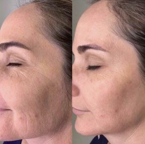 Customer photo review of NoolaWand™ Handset + FREE NoolaBar™ Microcurrent Device