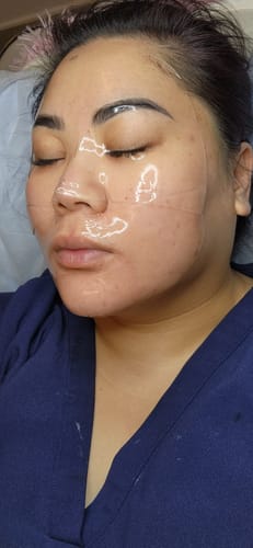 Customer photo review of Neogenesis Beta Glucan Hydrogel Mask