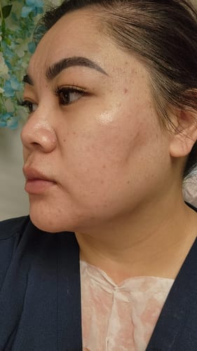 Customer photo review of KrX CO2 Carboxy Therapy