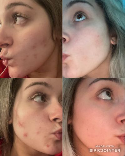 Customer photo review of Clear Skin All-Stars