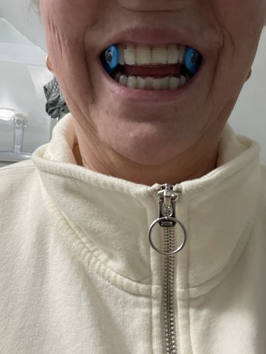 Customer photo review of Elastic Mandibular Advancement Device