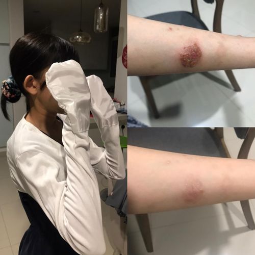Customer photo review of Eczema Scratch Mitten