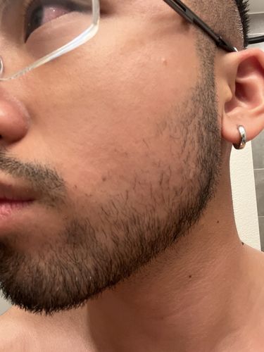 Customer photo review of 10% Tugain Foam Minoxidil Extra Strength Hair Regrowth for Men.