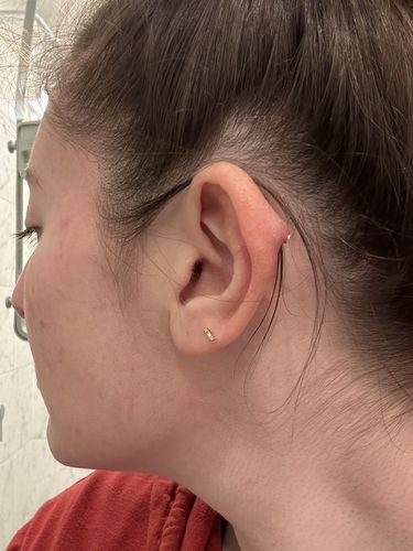 Customer photo review of Piercing Bump Treatment - Bump, Keloid & Scar Relief Oil