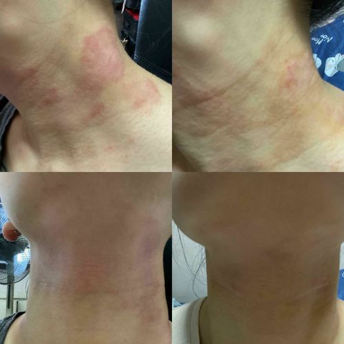 Customer photo review of Eczema Scratch Mitten