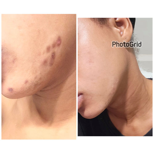 Customer photo review of Intense Discoloration Treatment (Rapid Action)