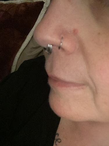Customer photo review of Piercing Bump Treatment - Bump, Keloid & Scar Relief Oil